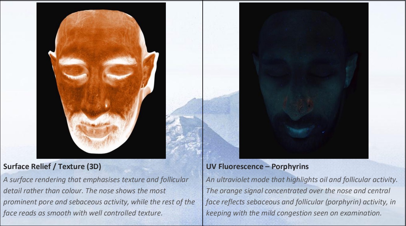 Two renderings from a 3D facial scan: a surface relief texture map, and a UV fluorescence view highlighting sebaceous and follicular activity